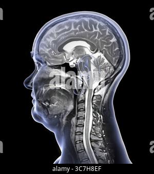 Abbildung einer farbigen Magnetresonanztomographie (MRT) des Gehirns und Halses, die die Anatomie des Zentralnervensystems und die Halswirbelsäule zeigt. Stockfoto