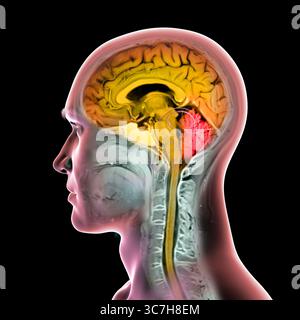 Abbildung einer farbigen Magnetresonanztomographie (MRT) des Gehirns und Halses, die die Anatomie des Zentralnervensystems und die Halswirbelsäule zeigt. Gehirn und Rückenmark sind orange und Kleinhirn rot hervorgehoben. Stockfoto