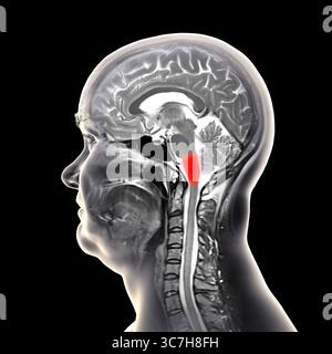 Abbildung einer farbigen Magnetresonanztomographie (MRT) der im menschlichen Gehirn hervorgehobenen Medulla oblongata. Dadurch werden Atmung, Herzschlag und andere wichtige autonome Funktionen gesteuert. Stockfoto