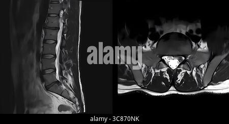 mrt-Scan der Lendenwirbelsäule in sagittaler und transversaler Ansicht. Der Patient hat einen Bandscheibenvorfall zwischen L5 und S1, der zu einer Nervenkompression führt. Untere Rückseite Healt oder Stockfoto