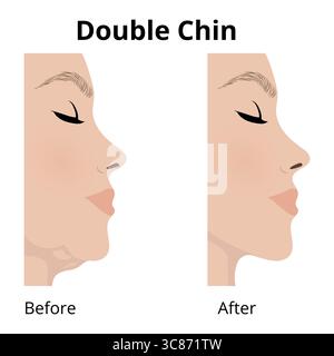 Profilansicht eines Frauengesichts, das die Transformation von einem Doppelkinn zu einem verfeinerten Kiefer veranschaulicht, wobei die Ergebnisse der kosmetischen Chirurgie oder hervorgehoben werden Stock Vektor