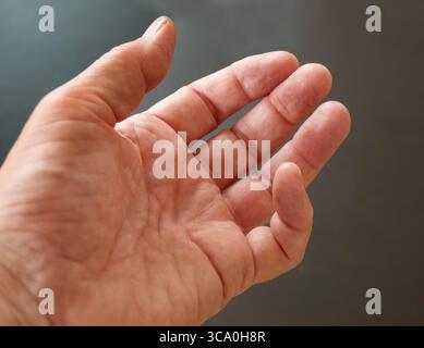 Hand einer Person mit Dupuytren-Kontraktur - ein Zustand, bei dem ein oder mehrere Finger dauerhaft in einer gebeugten Position gebogen werden. Kleiner Finger. Stockfoto