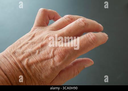 Hand einer Person mit Dupuytren-Kontraktur - ein Zustand, bei dem ein oder mehrere Finger dauerhaft in einer gebeugten Position gebogen werden. Kleiner Finger. Stockfoto