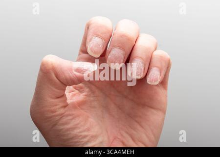 Detaillierte Nahaufnahme einer Hand, die spröde, trockene und abblätternde Nägel zeigt, mit dehydrierter Haut auf einem neutralen grauen Hintergrund. Konzept der Nagelgesundheit. Allerg Stockfoto