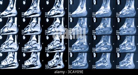 MRT-Magnetresonanztomographie des linken Fußes und Fußgelenks. Stockfoto