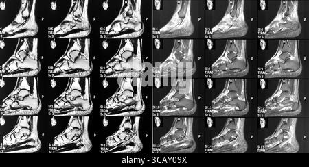 MRT-Magnetresonanztomographie des linken Fußes und Fußgelenks. Stockfoto