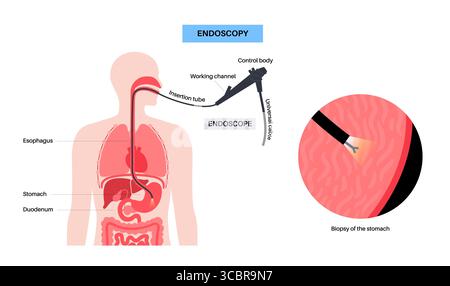 Abbildung einer Gastroskopie, auch als obere Endoskopie bezeichnet. Dies ist ein Verfahren, bei dem ein Endoskop durch den Mund eingeführt wird, um Ösophagus, Magen und Zwölffingerdarm zu untersuchen. Es hilft bei der Diagnose und Behandlung von Erkrankungen wie Geschwüren, Entzündungen oder Tumoren im oberen Verdauungstrakt. Stockfoto