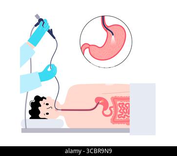 Abbildung einer Gastroskopie, auch als obere Endoskopie bezeichnet. Dies ist ein Verfahren, bei dem ein Endoskop durch den Mund eingeführt wird, um Ösophagus, Magen und Zwölffingerdarm zu untersuchen. Es hilft bei der Diagnose und Behandlung von Erkrankungen wie Geschwüren, Entzündungen oder Tumoren im oberen Verdauungstrakt. Stockfoto