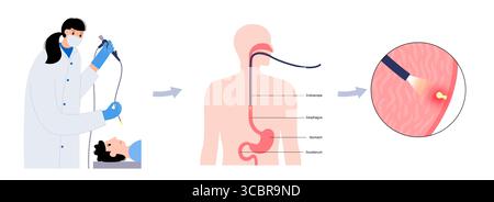 Abbildung einer Gastroskopie, auch als obere Endoskopie bezeichnet. Dies ist ein Verfahren, bei dem ein Endoskop durch den Mund eingeführt wird, um Ösophagus, Magen und Zwölffingerdarm zu untersuchen. Es hilft bei der Diagnose und Behandlung von Erkrankungen wie Geschwüren, Entzündungen oder Tumoren im oberen Verdauungstrakt. Stockfoto