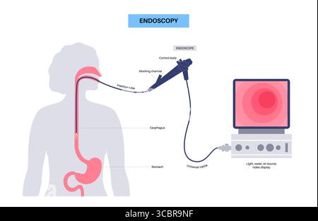 Abbildung einer Gastroskopie, auch als obere Endoskopie bezeichnet. Dies ist ein Verfahren, bei dem ein Endoskop durch den Mund eingeführt wird, um Ösophagus, Magen und Zwölffingerdarm zu untersuchen. Es hilft bei der Diagnose und Behandlung von Erkrankungen wie Geschwüren, Entzündungen oder Tumoren im oberen Verdauungstrakt. Stockfoto