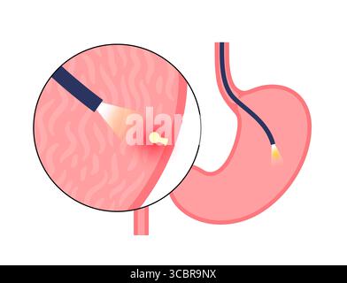 Abbildung einer Gastroskopie, auch als obere Endoskopie bezeichnet. Dies ist ein Verfahren, bei dem ein Endoskop durch den Mund eingeführt wird, um Ösophagus, Magen und Zwölffingerdarm zu untersuchen. Es hilft bei der Diagnose und Behandlung von Erkrankungen wie Geschwüren, Entzündungen oder Tumoren im oberen Verdauungstrakt. Stockfoto