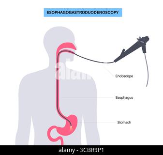 Abbildung einer Gastroskopie, auch als obere Endoskopie bezeichnet. Dies ist ein Verfahren, bei dem ein Endoskop durch den Mund eingeführt wird, um Ösophagus, Magen und Zwölffingerdarm zu untersuchen. Es hilft bei der Diagnose und Behandlung von Erkrankungen wie Geschwüren, Entzündungen oder Tumoren im oberen Verdauungstrakt. Stockfoto