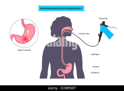 Abbildung einer Gastroskopie, auch als obere Endoskopie bezeichnet. Dies ist ein Verfahren, bei dem ein Endoskop durch den Mund eingeführt wird, um Ösophagus, Magen und Zwölffingerdarm zu untersuchen. Es hilft bei der Diagnose und Behandlung von Erkrankungen wie Geschwüren, Entzündungen oder Tumoren im oberen Verdauungstrakt. Stockfoto