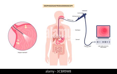 Abbildung einer Gastroskopie, auch als obere Endoskopie bezeichnet. Dies ist ein Verfahren, bei dem ein Endoskop durch den Mund eingeführt wird, um Ösophagus, Magen und Zwölffingerdarm zu untersuchen. Es hilft bei der Diagnose und Behandlung von Erkrankungen wie Geschwüren, Entzündungen oder Tumoren im oberen Verdauungstrakt. Stockfoto