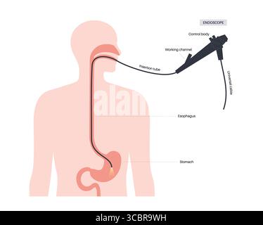 Abbildung einer Gastroskopie, auch als obere Endoskopie bezeichnet. Dies ist ein Verfahren, bei dem ein Endoskop durch den Mund eingeführt wird, um Ösophagus, Magen und Zwölffingerdarm zu untersuchen. Es hilft bei der Diagnose und Behandlung von Erkrankungen wie Geschwüren, Entzündungen oder Tumoren im oberen Verdauungstrakt. Stockfoto