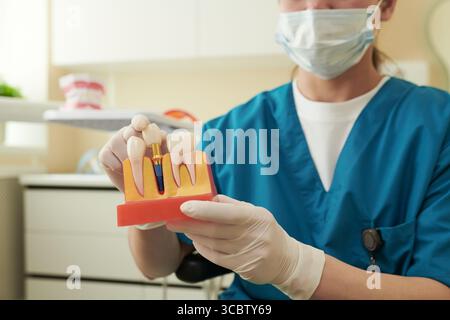 Kaukasische junge Erwachsene Frau mit medizinischer Maske und Handschuhen, die ein Zahnimplantatmodell hält, das Zahnstruktur und Implantatverfahren in der zahnärztlichen Klinik demonstriert Stockfoto