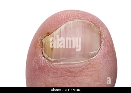 Zehennagelpilz Nahaufnahme mit einem menschlichen Fuß isoliert auf weißem Hintergrund. Nagelpilzinfektionsmakro. Stockfoto