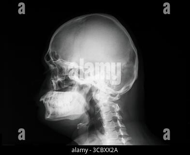 MRT-Magnetresonanzbild des menschlichen Schädels. Seitliche Seitenansicht. Röntgenbild des menschlichen Kopfes. Stockfoto
