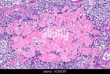 Lichtmikrographie eines Corpus albicans. Corpora albicantia (Singular: Corpus albicans) sind die Überreste im Ovar des Corpus luteum, das sich nach dem Ovulation bildet, wenn keine Befruchtung stattfindet. Das Corpus albicans besteht aus fibrösem Gewebe (rosa), wie es hier unter ovarialem Stroma (blaue Punkte) und einigen Blutgefäßen (kreisförmige Strukturen oben rechts und unten links im Bild) zu sehen ist. Hämatoxylin- und Eosin-gefärbter Gewebeschnitt. Vergrößerung: 200-fach bei 10 cm Druck. Stockfoto