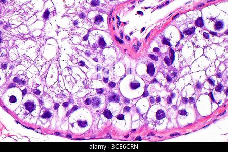 Lichtmikrographie der Keimzellneoplasia in situ (GCNIS). Bei Hoden, die von Keimzelltumoren betroffen sind, ist GCNIS häufig ein Befund. Diese besteht aus vergrößerten Zellen mit großen Kernen (dunkelblaue Punkte) und reichlich klarem Zytoplasma (weiß). Die Zellen befinden sich innerhalb der Grenzen der Tubuluswände (rosa) innerhalb des Hodens. Hämatoxylin- und Eosin-gefärbter Gewebeschnitt. Vergrößerung: 400-fach bei 10 cm Druck. Stockfoto