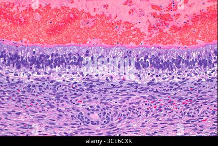 Lichtmikrograph des Hodentteratoms. Teratome sind Tumoren, die aus Reproduktions- oder Keimzellen stammen. Teratome weisen eine Vielzahl von Gewebetypen auf, wie z. B. die Drüsenzellen (horizontales Band in der Bildmitte), die von unreifen mesenchymalen Zellen (blau-violette verlängerte Punkte, die das untere Drittel des Bildes einnehmen) umgeben sind. Das Lumen dieser Drüsenstruktur (oberes Drittel des Bildes) enthält rote Blutkörperchen (hellrot). Hämatoxylin- und Eosin-gefärbter Gewebeschnitt. Vergrößerung: 200-fach bei 10 cm Druck. Stockfoto