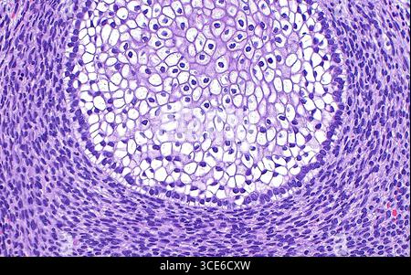 Lichtmikrograph des Hodentteratoms. Teratome sind Tumoren, die aus Reproduktions- oder Keimzellen stammen. Teratome weisen eine Vielzahl von Gewebetypen auf, z. B. Plattenepithelzellen (weiße kreisförmige Fläche), die von unreifen mesenchymalen Zellen (blau-violett gestreckte Punkte, die Peripherien besetzen) umgeben sind, in diesem mikroskopischen Bild eines Hodentteratoms. Hämatoxylin- und Eosin-gefärbter Gewebeschnitt. Vergrößerung: 200-fach bei 10 cm Druck. Stockfoto