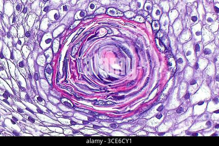 Lichtmikrograph des Hodentteratoms. Teratome sind Tumoren, die aus Reproduktions- oder Keimzellen stammen. Teratome weisen eine Vielzahl von Gewebetypen auf, z. B. Plattenepithelzellen (weiße polygonale Strukturen) in diesem mikroskopischen Bild eines Hodenteratoms. Hier zeigen die Plattenepithelzellen eine Verkeratinisierung oder die Bildung von Keratinmaterial, das die dunklere rosa und blaue Kreisstruktur in der Bildmitte darstellt. Hämatoxylin- und Eosin-gefärbter Gewebeschnitt. Vergrößerung: 400-fach bei 10 cm Druck. Stockfoto