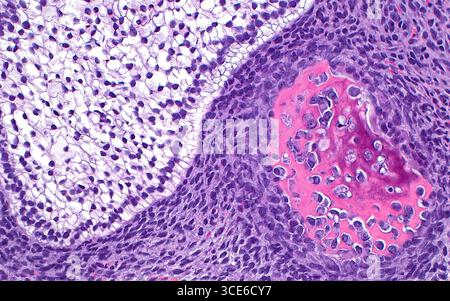 Lichtmikrograph des Hodentteratoms. Teratome sind Tumoren, die aus Reproduktions- oder Keimzellen stammen. Teratome weisen eine Vielzahl von Gewebetypen auf, z. B. Plattenepithelzellen (weißer Bereich in der linken Bildhälfte), umgeben von unreifen mesenchymalen Zellen (Bereich mit blau-violetten verlängerten Punkten) und angrenzenden Knochen (rosa Struktur in der rechten Bildhälfte) in diesem mikroskopischen Bild eines Hodenteratoms. Hämatoxylin- und Eosin-gefärbter Gewebeschnitt. Vergrößerung: 200-fach bei 10 cm Druck. Stockfoto