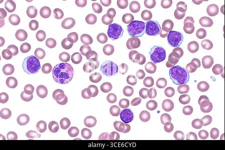 Lichtmikroskop einer kleinen lymphatischen Leukämie, einer Art Blutkrebs. Die Leukämiezellen sind die dunkelvioletten und blauen runden Strukturen, von denen neun im Bildfeld zu sehen sind. Ein etwas größeres Neutrophil ist ebenfalls vorhanden (rechts neben der ersten Leukämiezelle links ganz im Bild). Im Hintergrund sind mehrere rote Blutkörperchen (kleinere, blassrote Kreise) zu sehen. Peripherer Blutausstrich. Vergrößerung: 600-fach bei 10 cm Druck. Stockfoto