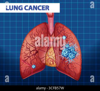 Illustration menschlicher Lungen mit Krebszellen, mit detaillierter Anatomie und lebendigen Farben vor einem Gitterhintergrund Stock Vektor
