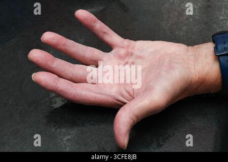 London, Kanada. August 2025. Männliche Hand würdigt mit Dupuytren-Krankheit. Luke Durda/Alamy. Stockfoto