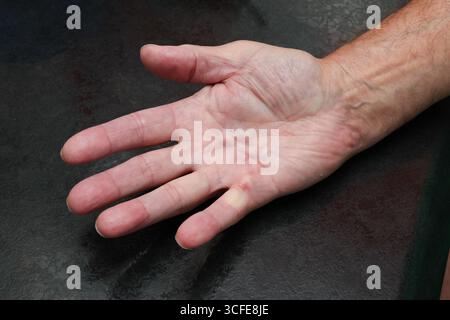London, Kanada. August 2025. Männliche Hand würdigt mit Dupuytren-Krankheit. Luke Durda/Alamy. Stockfoto