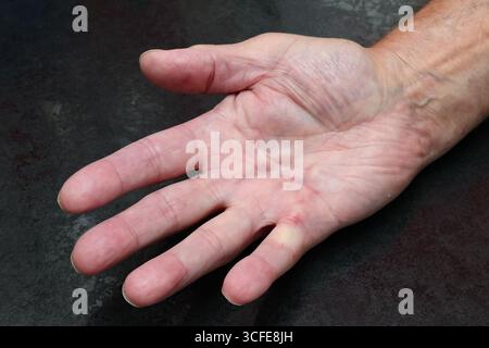 London, Kanada. August 2025. Männliche Hand würdigt mit Dupuytren-Krankheit. Luke Durda/Alamy. Stockfoto