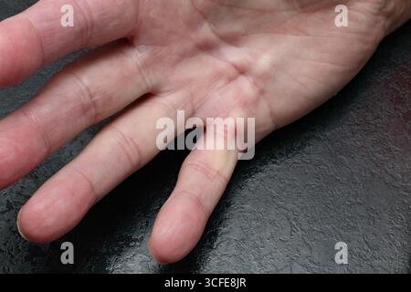 London, Kanada. August 2025. Männliche Hand würdigt mit Dupuytren-Krankheit. Luke Durda/Alamy. Stockfoto