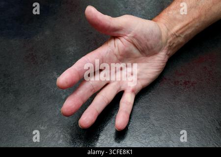 London, Kanada. August 2025. Männliche Hand würdigt mit Dupuytren-Krankheit. Luke Durda/Alamy. Stockfoto