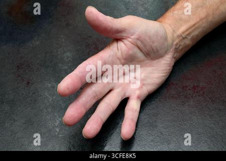 London, Kanada. August 2025. Männliche Hand würdigt mit Dupuytren-Krankheit. Luke Durda/Alamy. Stockfoto