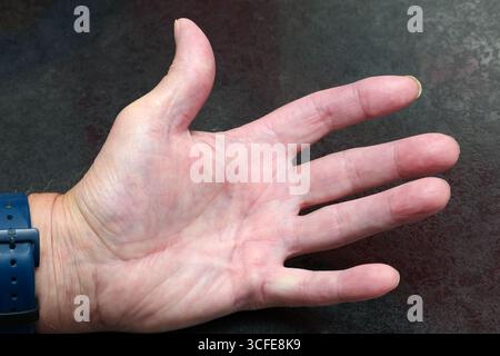 London, Kanada. August 2025. Männliche Hand würdigt mit Dupuytren-Krankheit. Luke Durda/Alamy. Stockfoto