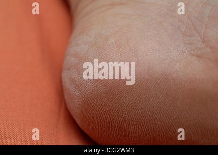 Nahaufnahme trockener Fersenhaut mit Anzeichen von Dehydrierung und Rissbildung Stockfoto