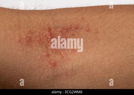 Hautallergiesymptome zeigen roten Ausschlag am menschlichen Arm Stockfoto