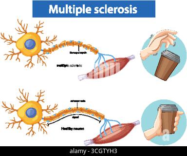 Vektor-Illustration zum Vergleich gesunder und multipler Sklerose-Neuronen mit markierten Myelinschäden und Bewegungsstörungen. Stock Vektor
