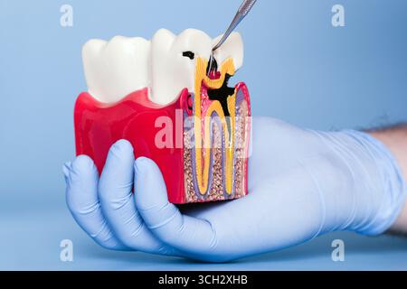 Nahaufnahme einer Hand mit Handschuhen, die ein Dentalmodell mit fortgeschrittenem Karies hält Stockfoto