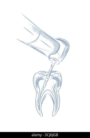 Zahnbehandlung mit Dentalbohrer-Illustrationszeichnung in grafischem Stil mit blauem auf weißem Hintergrund Stock Vektor