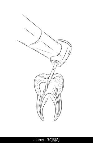 Zahnbehandlung mit Dentalbohrer-Illustrationszeichnung im grafischen Stil mit schwarzem auf weißem Hintergrund Stock Vektor