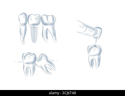 Bohren Sie den Zahn mit einer Dentalmaschine, implantieren, entfernen Sie kranke Zähne Illustrationen in grafischem Stil mit blauem auf weißem Hintergrund. Stock Vektor