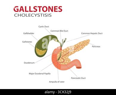 Medizinische Darstellung von Gallensteinen und Cholezystitis in der Gallenblase mit markierter Verdauungssystemanatomie. Stock Vektor