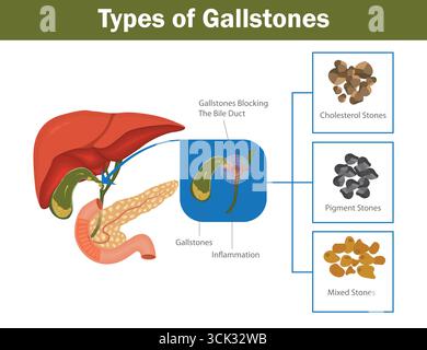 Arten von Gallensteinen medizinisches Diagramm mit Cholesterinsteinen, Pigmentsteinen, Mischsteinen und Gallensteinblockade im Gallengang. Stock Vektor