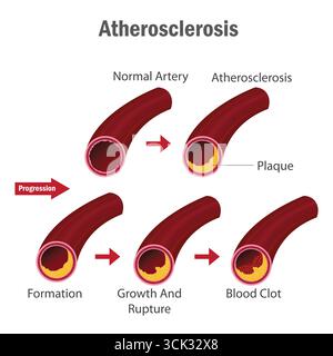 Atherosklerosestadien Infografik, die die Bildung von Arterienplaques, Wachstum, Ruptur und die Entwicklung von Blutgerinnseln im menschlichen Kreislaufsystem zeigt. Stock Vektor