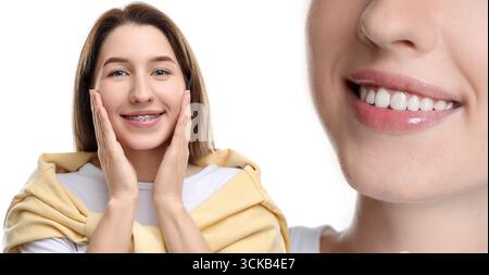 Frau, die perfekte Zähne zeigt, weil Zahnspangen auf weißem Hintergrund verwendet wurden, Nahaufnahme. Collage mit vorher- und Nachher-Fotos Stockfoto