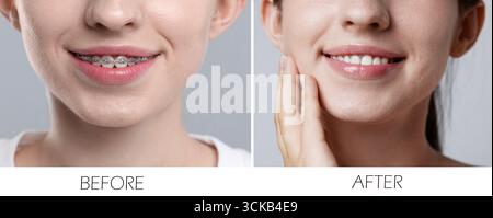 Frau, die Zähne zeigt, während und nach der Verwendung von Zahnspangen, Nahaufnahme. Collage von Fotos auf grauem Hintergrund Stockfoto
