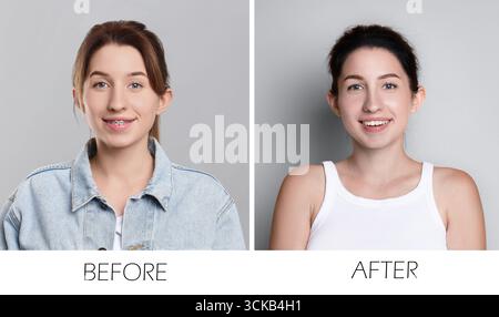 Collage mit Fotos einer Frau mit Zahnspangen und perfekten Zähnen auf grauem Hintergrund. Vorher und nachher Stockfoto
